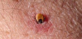 What to do when a tick bite