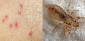 Linen lice bites