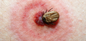 Borrelia mites and the effects of their bites