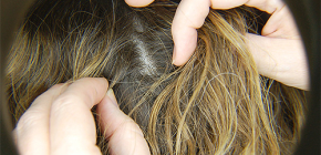 How to treat lice and nits