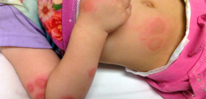 Bites of bed bugs in children