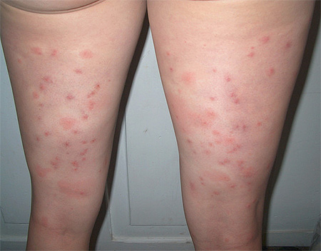 Bites of bedbugs on the legs of a woman