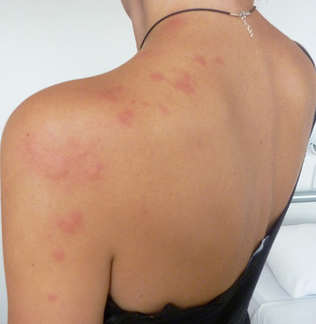 Bug bites