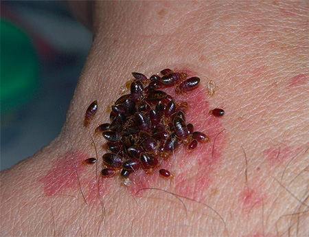 Multiple bedbug bites