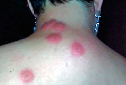 Bedbug Allergy