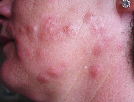 Bedbug swelling