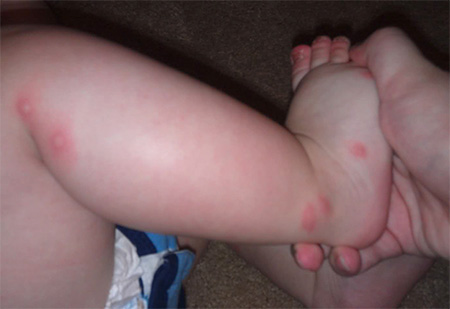 Bites of bedbugs on the leg of a child