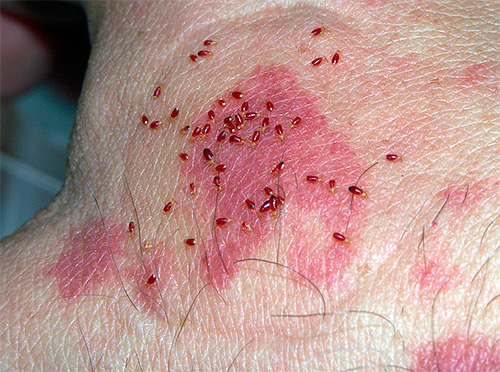 Bug larvae on the skin