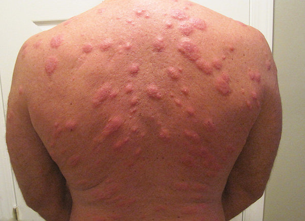 Ofta utvecklas en allvarlig allergisk reaktion till homebugbett, och kroppstemperaturen kan stiga.