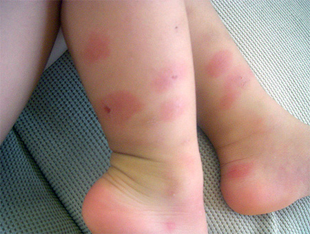 Bedbug Allergy