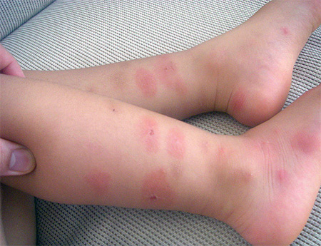 Allergisk reaktion hos ett barn till bedbug bites
