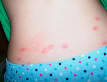 Bedbug biter på babyens rygg