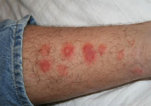 Characteristic bed bug bite