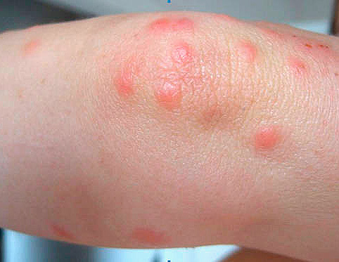 Rödhet från bedbug bites på ett barns ben