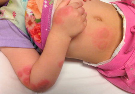 Exempel på en mild allergisk reaktion på bedbugs