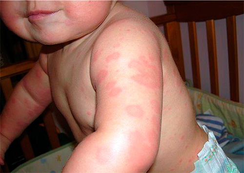 Ett exempel på ett barns allergi mot bedbug bites