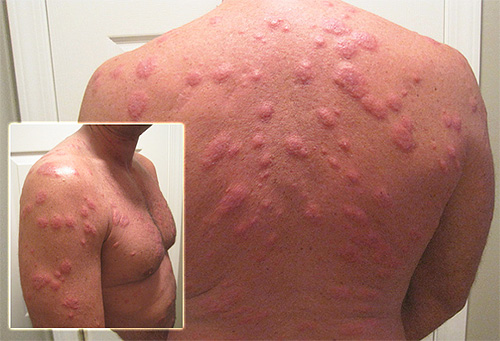 Många bedbug biter på kroppen av en vuxen man