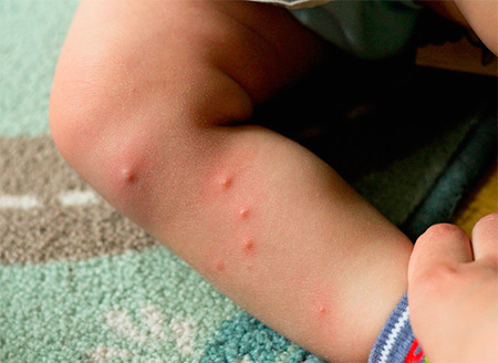 Flea bites on baby leg
