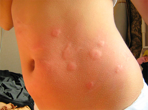 Photo: Flea bites on the body of a child