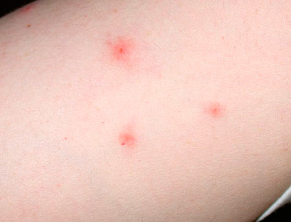 Small hemorrhages from flea bites
