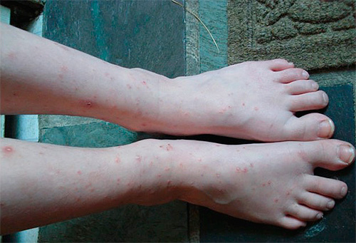 Multiple flea bites in children are often accompanied by a rash.