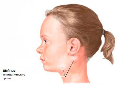 Swollen lymph nodes may be a sign of a generalized allergic reaction.