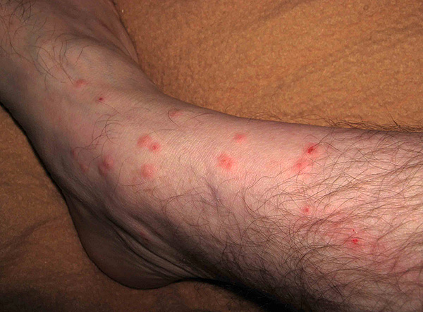 Sometimes, even briefly going down to the basement of the house, you can get multiple flea bites (often suffer legs).
