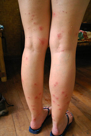 Flea bites on the legs