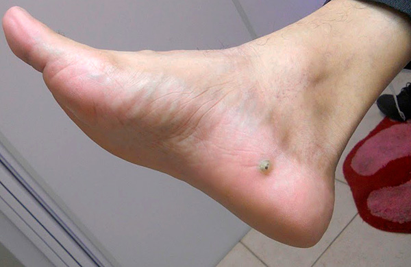 A wound on the leg is a sandy flea under the skin (also called an earthen flea).