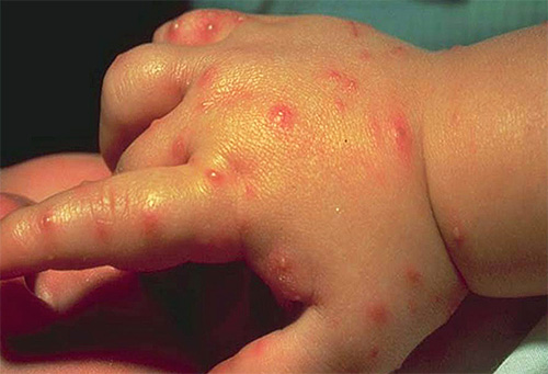 The bites of nomadic ants on the hand of a child