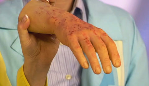 Symtom på tyfus på handens hud