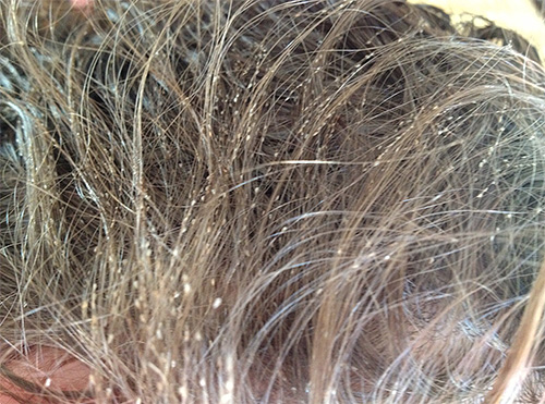 Så här ser hår ut när det är tungt infekterat med huvudlöss.