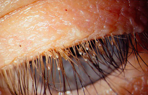 Lice and their nits on the eyelashes