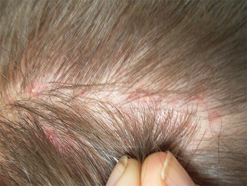 Signs of head lice