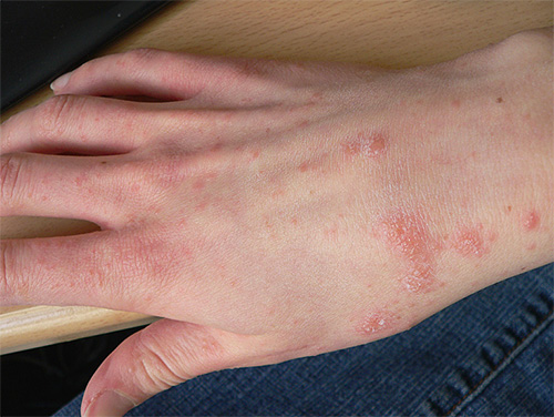 Rash on the skin of the hands during scabies