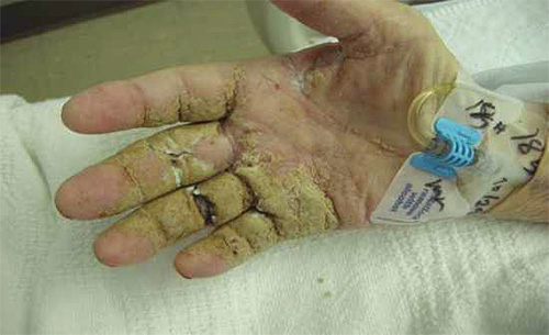Man's hand with signs of Norwegian scabies