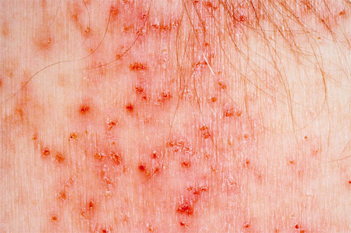 Bites of bed lice