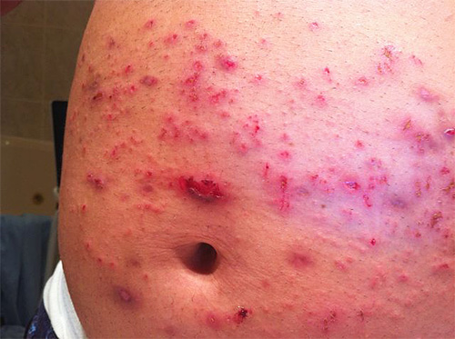 Bites of bed lice, especially if they are combed, are fraught with the appearance of serious ulcers and inflammations.
