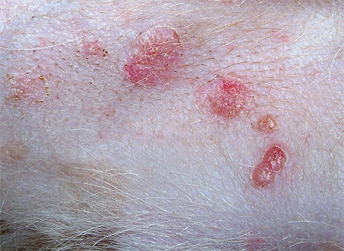 Pyoderma (purulent skin lesion) caused by the bites of lice