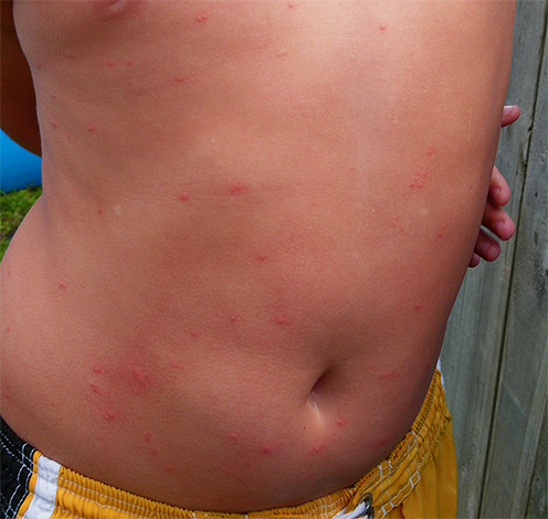 Linen lice infect areas of the body that are hidden by clothing, unlike, for example, mosquitoes.