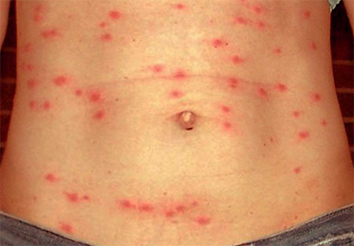 Manifestations of typhus on the skin of the abdomen