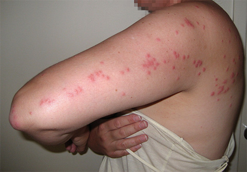Bedbug biter finns vanligtvis på kroppen i form av en gångväg.