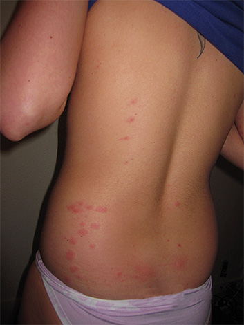 Lice bites on the back