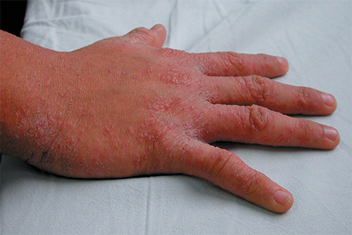 I bilden - manifestationer av scabies på handens hud