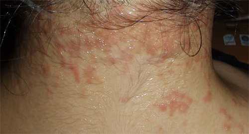 Neck rash caused by head lice bites