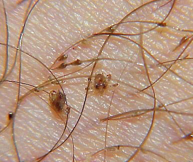 Pubic louse on the skin
