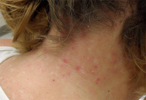 Among the manifestations of pediculosis in children, the main place is occupied by lice bites in the neck and head, which may be accompanied by an allergic reaction.