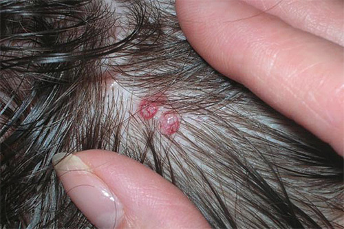 Lice in a child is also dangerous due to the fact that purulent inflammations sometimes form in places of combed bites