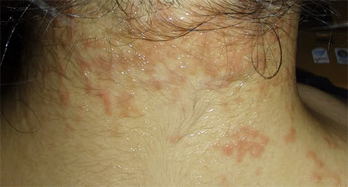 If the skin is prone to allergic rashes, then Full Marks should be used with caution.