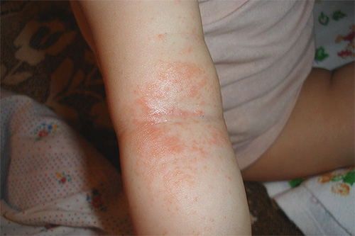 If there are rashes on the elbow after a test for kerosene, then it cannot be used to remove lice.